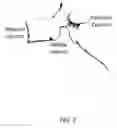 Fig. 02 - Three column spinal fixation implants and associated surgical methods