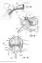 Fig. 06 - B-shaped interbody implant