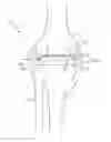 Fig. 01 - Dynamic knee balancer with force or pressure sensing