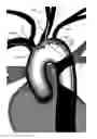 Fig. 01 - Apparatus and method for a bifurcated catheter for use in hostile aortic arches
