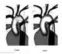Fig. 03 - Apparatus and method for a bifurcated catheter for use in hostile aortic arches