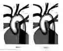 Fig. 04 - Apparatus and method for a bifurcated catheter for use in hostile aortic arches