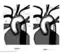Fig. 05 - Apparatus and method for a bifurcated catheter for use in hostile aortic arches