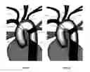 Fig. 09 - Apparatus and method for a bifurcated catheter for use in hostile aortic arches