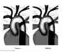 Fig. 10 - Apparatus and method for a bifurcated catheter for use in hostile aortic arches