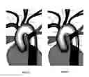 Fig. 11 - Apparatus and method for a bifurcated catheter for use in hostile aortic arches