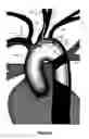 Fig. 12 - Apparatus and method for a bifurcated catheter for use in hostile aortic arches