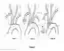 Fig. 02 - Apparatus and method for stabilization of procedural catheter in tortuous vessels