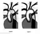 Fig. 03 - Apparatus and method for stabilization of procedural catheter in tortuous vessels