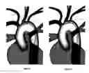 Fig. 04 - Apparatus and method for stabilization of procedural catheter in tortuous vessels
