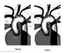 Fig. 05 - Apparatus and method for stabilization of procedural catheter in tortuous vessels