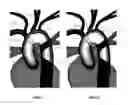 Fig. 09 - Apparatus and method for stabilization of procedural catheter in tortuous vessels