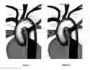 Fig. 10 - Apparatus and method for stabilization of procedural catheter in tortuous vessels