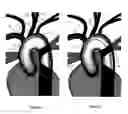 Fig. 11 - Apparatus and method for stabilization of procedural catheter in tortuous vessels