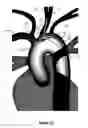 Fig. 12 - Apparatus and method for stabilization of procedural catheter in tortuous vessels