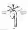 Fig. 15 - Apparatus and method for stabilization of procedural catheter in tortuous vessels