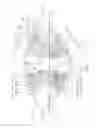 Fig. 23 - System and method for improving the accomodative amplitude and increasing the refractive power of the human lens with a laser