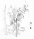 Fig. 12 - System and method for treatment of eustachian tube from middle ear approach