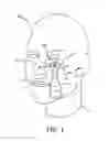 Fig. 02 - LOWER EYELID TREATMENT