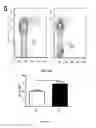 Fig. 14 - Composition comprising a combination of DNA methylation inhibitor and a vitamin D receptor agonist for the treatment of drug resistant cancer or for the prevention of tumor relapse