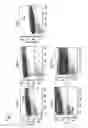 Fig. 02 - Method for non surgical repair of vertebral compression fractures