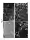 Fig. 09 - Method for non surgical repair of vertebral compression fractures