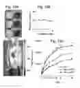 Fig. 16 - Method for non surgical repair of vertebral compression fractures