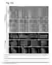 Fig. 22 - Method for non surgical repair of vertebral compression fractures