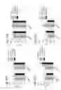 Fig. 28 - Method for non surgical repair of vertebral compression fractures