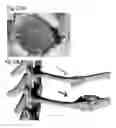 Fig. 33 - Method for non surgical repair of vertebral compression fractures