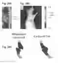Fig. 35 - Method for non surgical repair of vertebral compression fractures