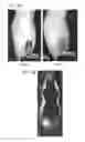 Fig. 31 - REFILLABLE DRUG DELIVERY DEVICES AND METHODS OF USE THEREOF