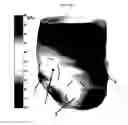 Fig. 34 - Methods and compositions for stabilizing the myocardium