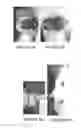 Fig. 09 - Biocompatible and bioabsorbable derivatized chitosan compositions
