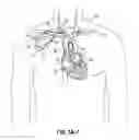 Fig. 03 - Devices, methods and systems for establishing supplemental blood flow in the circulatory system