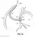 Fig. 08 - Devices, methods and systems for establishing supplemental blood flow in the circulatory system