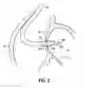 Fig. 11 - Devices, methods and systems for establishing supplemental blood flow in the circulatory system