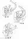 Fig. 14 - Devices, methods and systems for establishing supplemental blood flow in the circulatory system