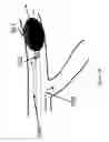 Fig. 14 - Systems and methods for providing zones of selective thermal therapy