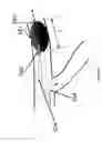 Fig. 15 - Systems and methods for providing zones of selective thermal therapy