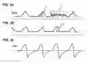Fig. 03 - Device for the pressure-supported or pressure-controlled ventilation of a patient with reduced spontaneous breathing