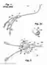 Fig. 02 - CENTRAL VENOUS CATHETER WITH REMOVABLE SIDE PORTS