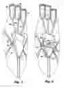 Fig. 03 - CENTRAL VENOUS CATHETER WITH REMOVABLE SIDE PORTS