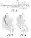 Fig. 04 - Anchor device for use with catheters