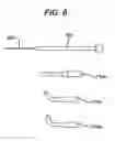 Fig. 10 - Medical device and method for treatment of a sinus opening