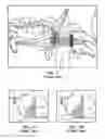 Fig. 02 - Method of stimulating a hypoglossal nerve for controlling the position of a patients tongue