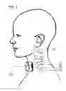 Fig. 09 - NERVE STIMULATION METHODS FOR AVERTING IMMINENT ONSET OR EPISODE OF A DISEASE