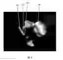 Fig. 12 - Systems and methods for imaging and ablating tissue