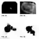 Fig. 03 - MEGAKARYOCYTE AND PLATELET PRODUCTION FROM STEM CELLS