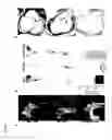 Fig. 05 - METHOD OF TREATING HYPERLIPIDEMIA AND ATHEROSCLEROSIS WITH MIR-30C